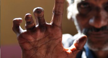 බස්නාහිර පළාතේ ලාදුරු රෝගීන් ගැන භයානක හෙළිදරව්වක් !