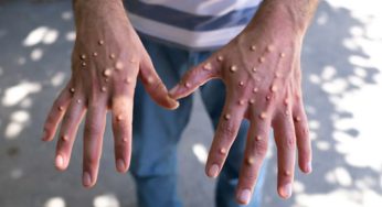 පාකිස්ථානයෙන් හමු වූ Mpox ආසාදිතයන් ගණන 6 දක්වා ඉහළට !